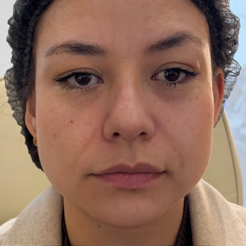 Antes — harmonização facial
