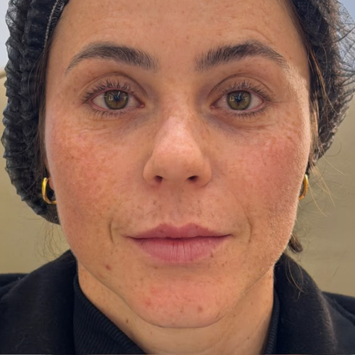 Antes — definição facial