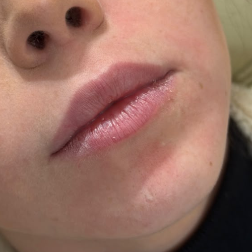 Antes — preenchimento labial